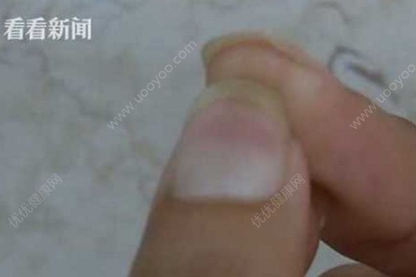 男子杀鱼时不小心划伤手指，几个月后右手手臂被