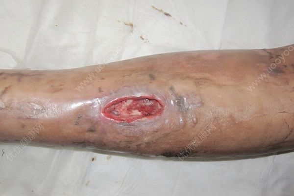男子杀鱼时不小心划伤手指，几个月后右手手臂被