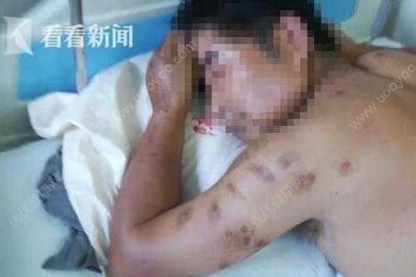 夫妻修缮屋顶误捅蜂窝，丈夫被蜇一百多下成